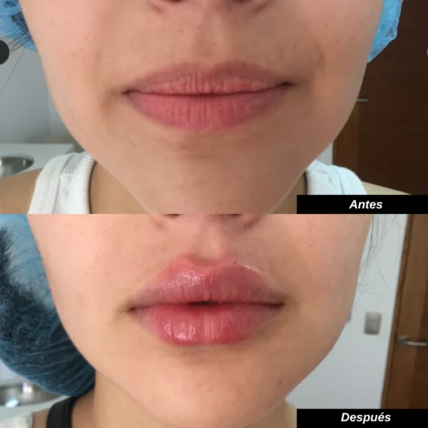 Aumento / Hidratación de labios (1 jeringa de 1ml)