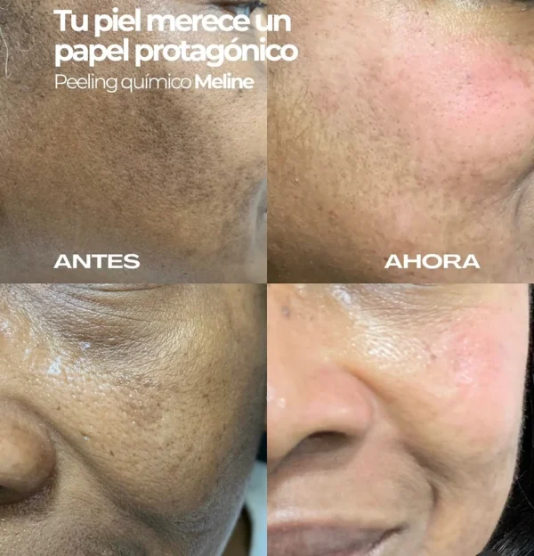 Peeling despigmentante protocolo Meline