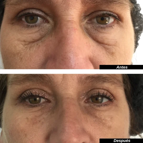 Relleno de ojeras (Incluye 1 jeringa de 1ml).