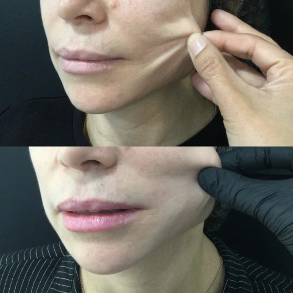 Sculptra