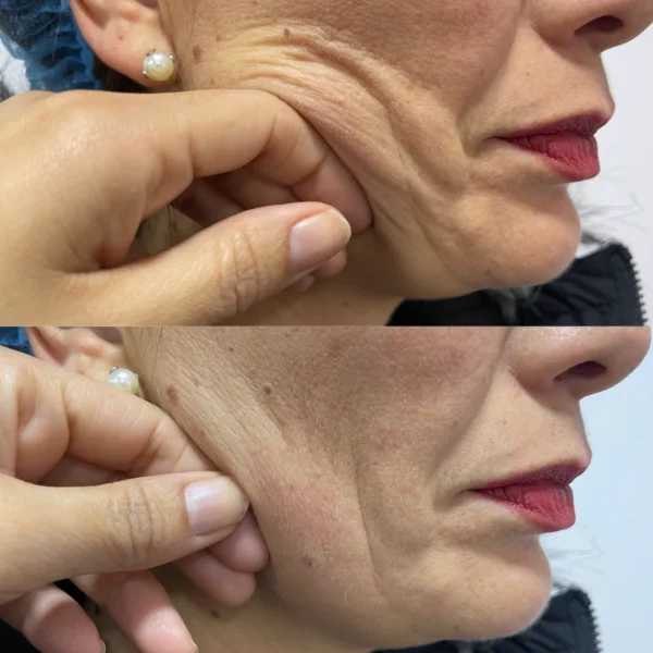 Skinboosters