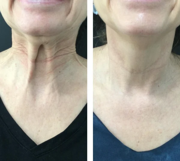 Toxina botulínica en cuello y contorno mandibular